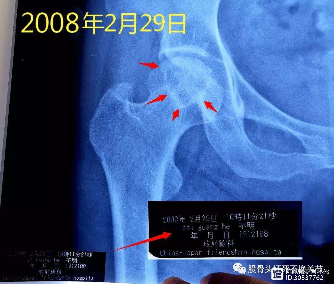 北海人工骨头医保报销多少(人工骨头医保报销多少比例)
